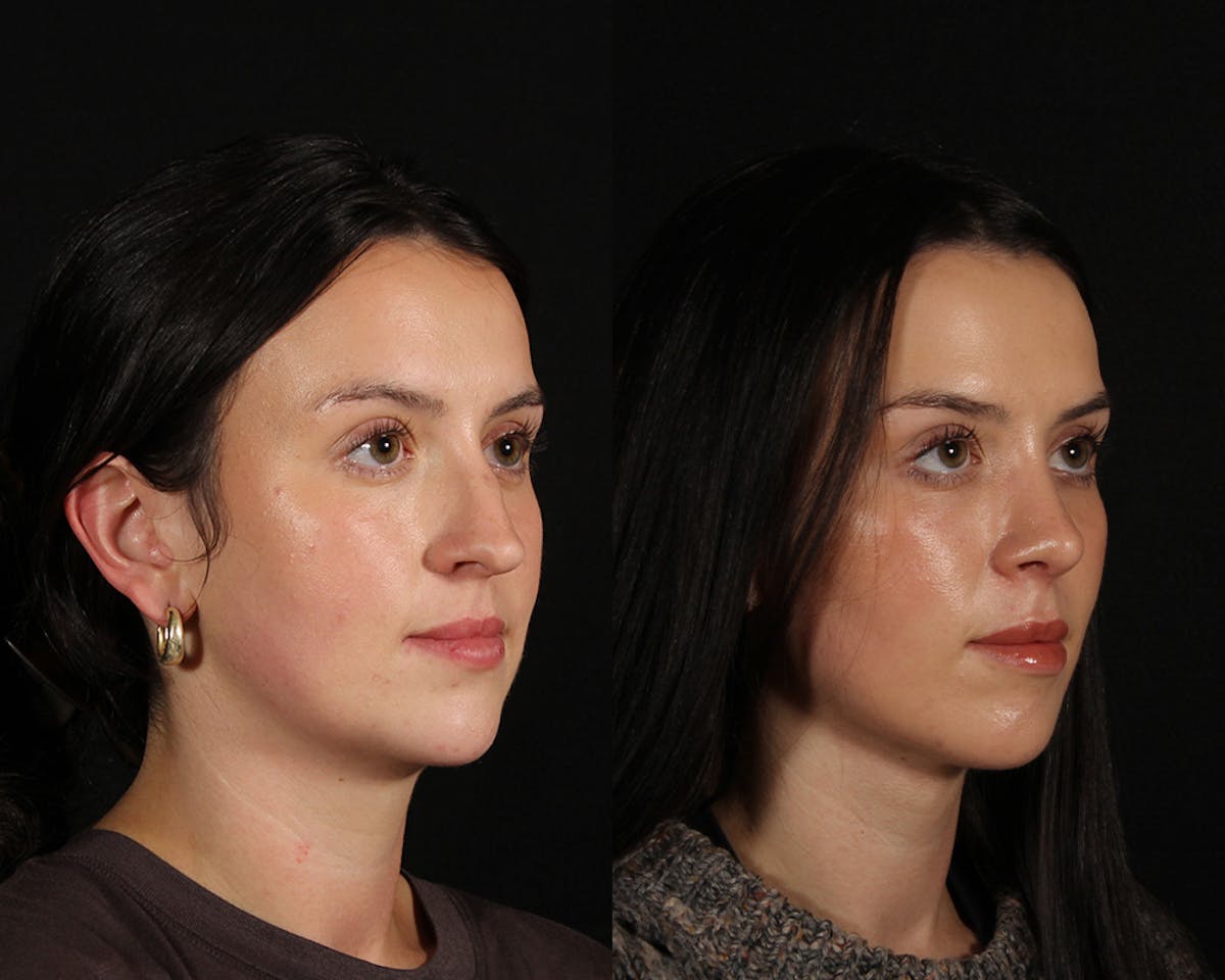 Face & Neck Lift Before & After Gallery - Patient 283266 - Image 2
