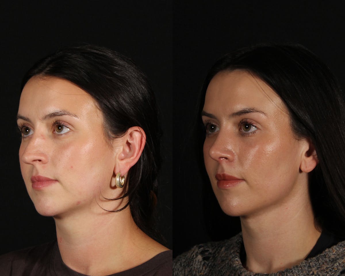 Face & Neck Lift Before & After Gallery - Patient 283266 - Image 3