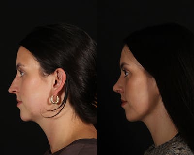 Rhinoplasty Female Before & After Gallery - Patient 180200 - Image 1