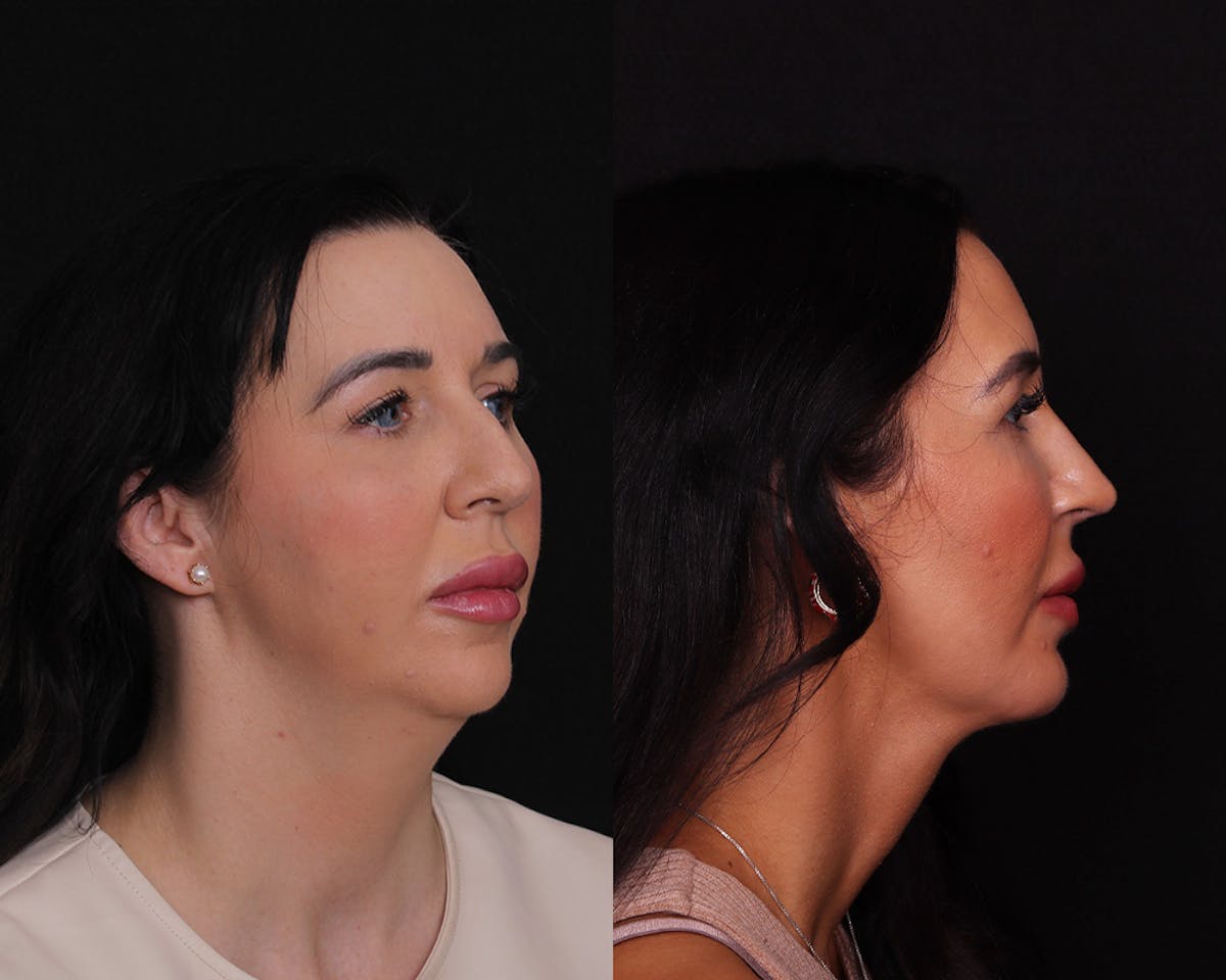 Face & Neck Lift Before & After Gallery - Patient 314084 - Image 3