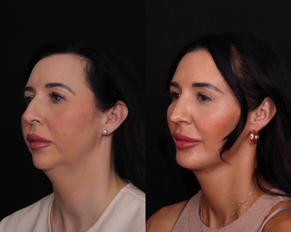Face & Neck Lift Before & After Gallery - Patient 314084 - Image 1