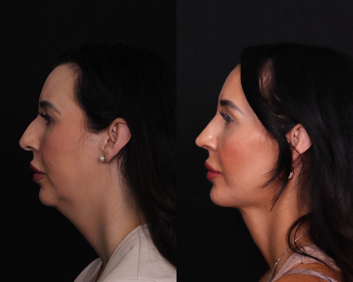 Face & Neck Lift Before & After Gallery - Patient 314084 - Image 2
