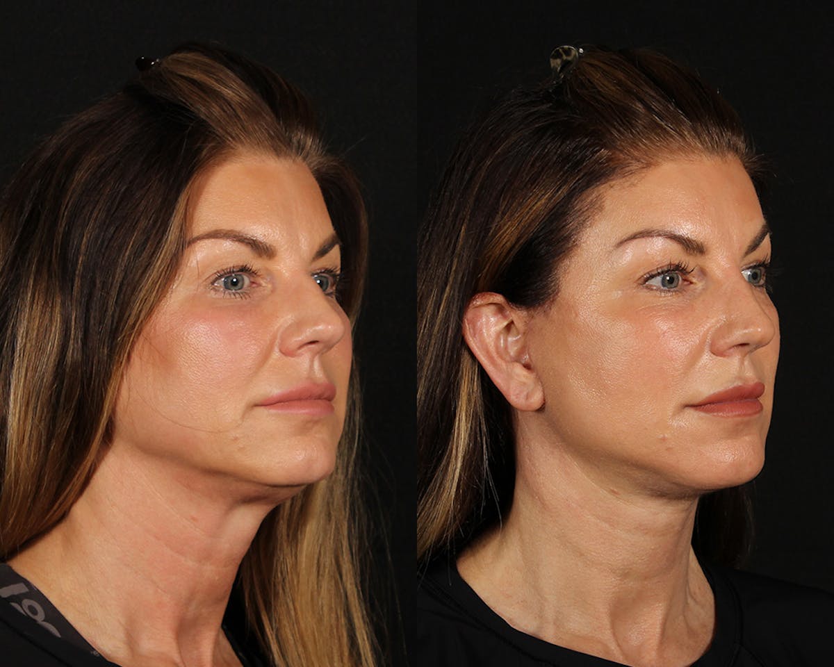 Face & Neck Lift Before & After Gallery - Patient 225591 - Image 2