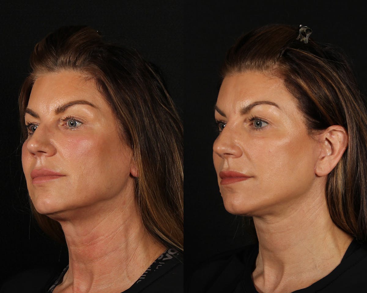 Face & Neck Lift Before & After Gallery - Patient 225591 - Image 3