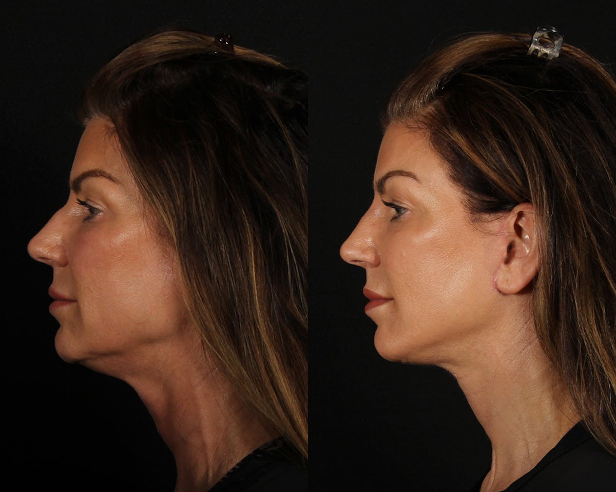 Face & Neck Lift Before & After Gallery - Patient 225591 - Image 4