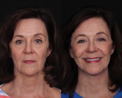 Face & Neck Lift Before & After Gallery - Patient 101202 - Image 1