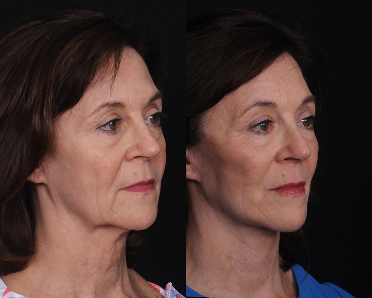 Face & Neck Lift Before & After Gallery - Patient 101202 - Image 2
