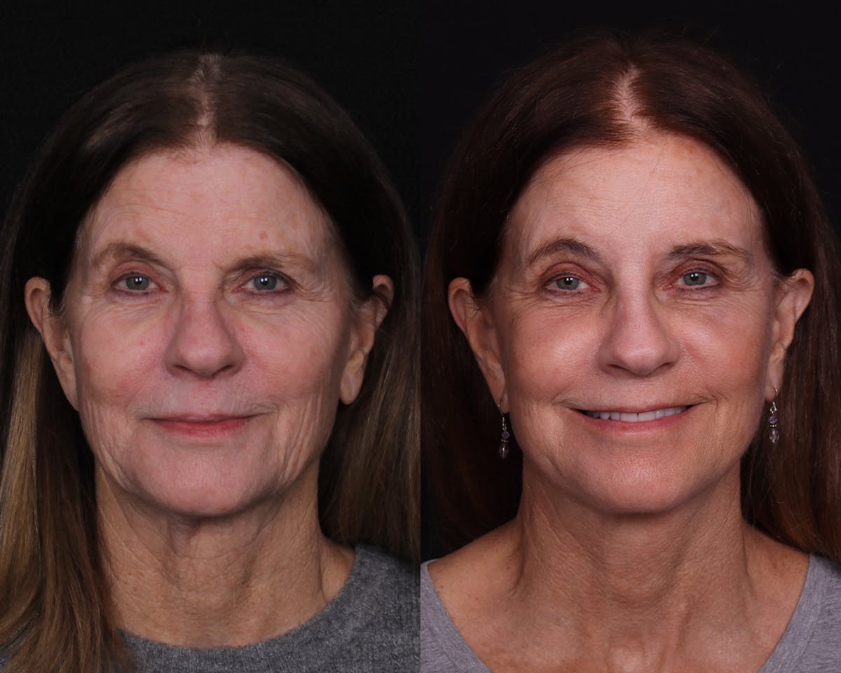 Face & Neck Lift Before & After Gallery - Patient 104507 - Image 1