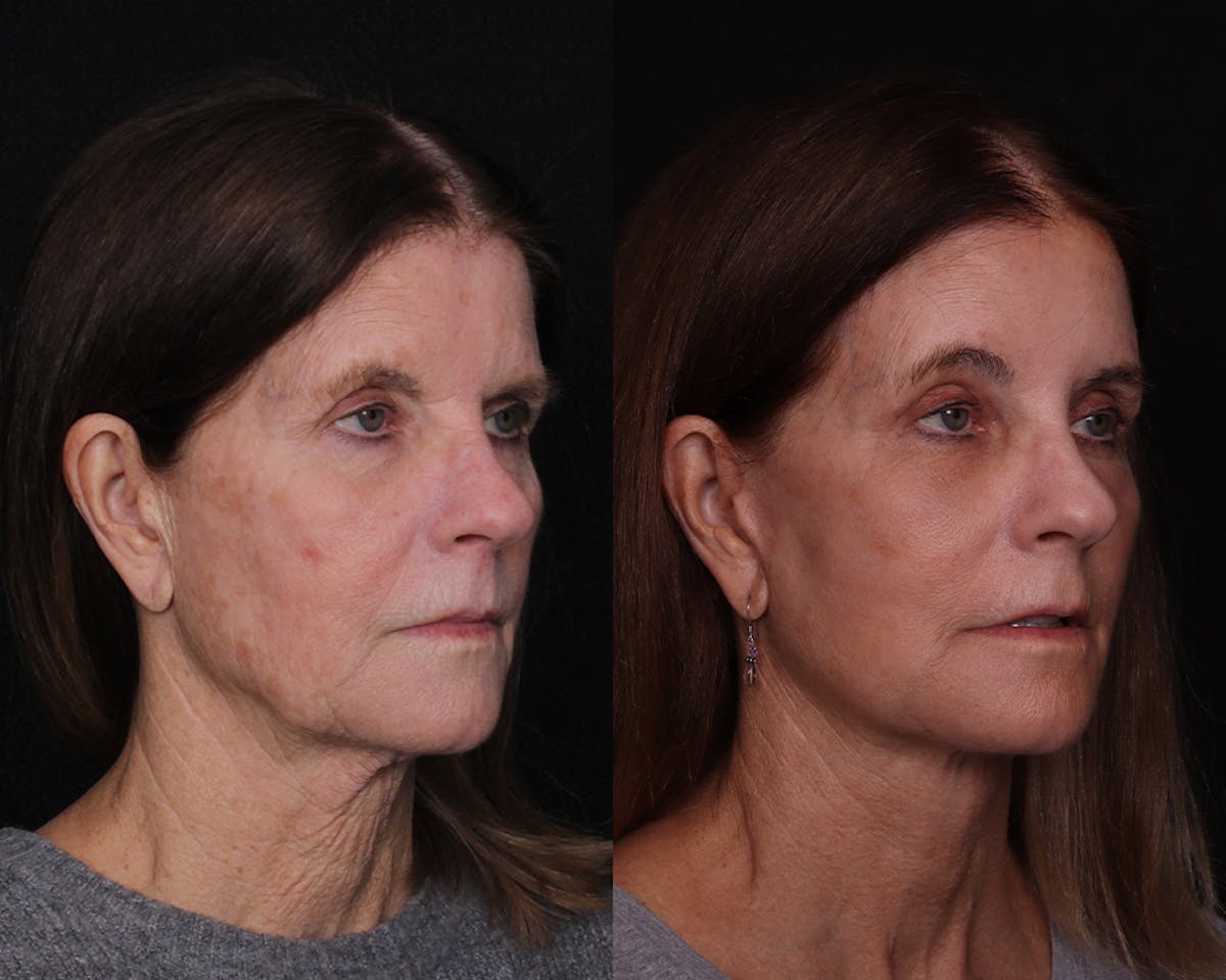 Face & Neck Lift Before & After Gallery - Patient 104507 - Image 2