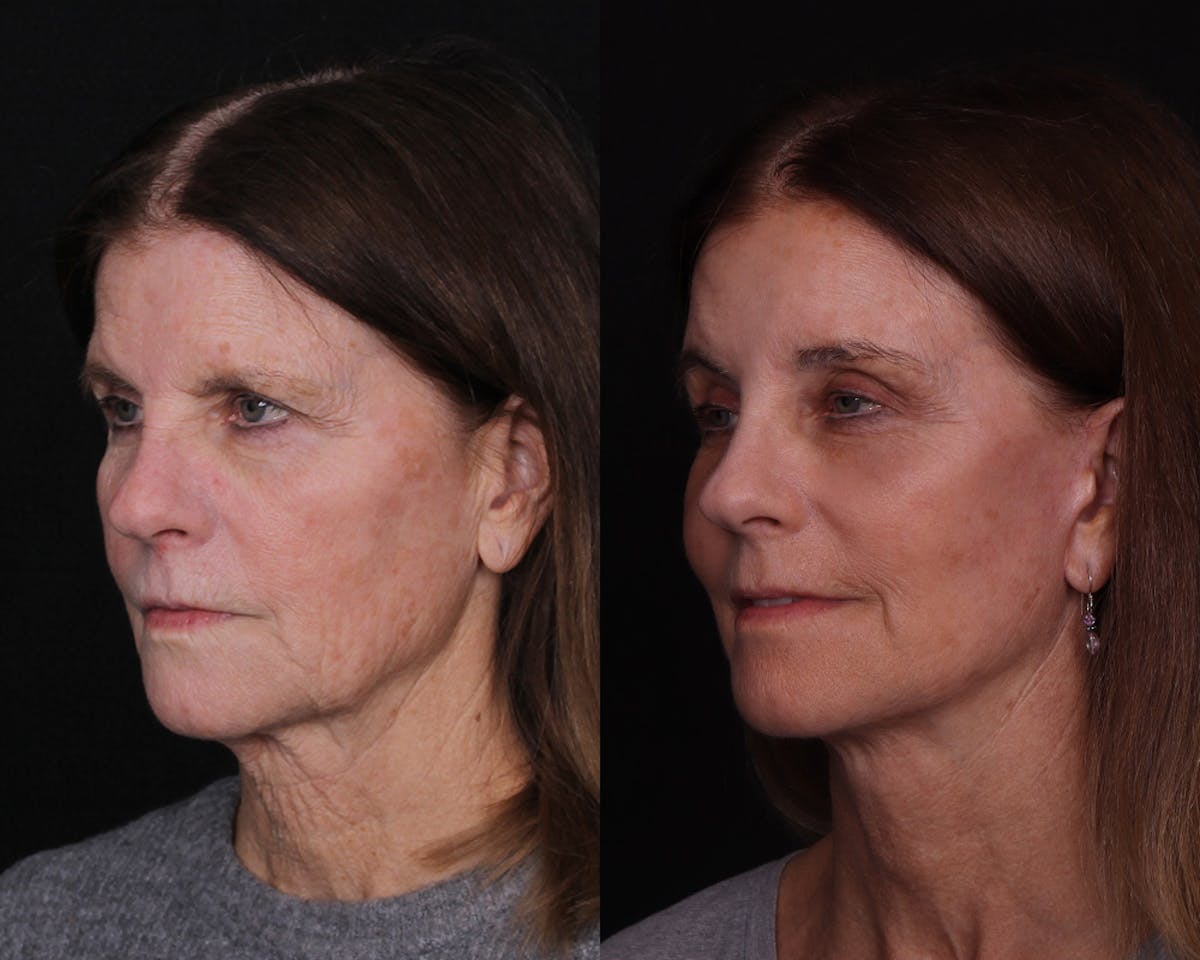 Face & Neck Lift Before & After Gallery - Patient 104507 - Image 3