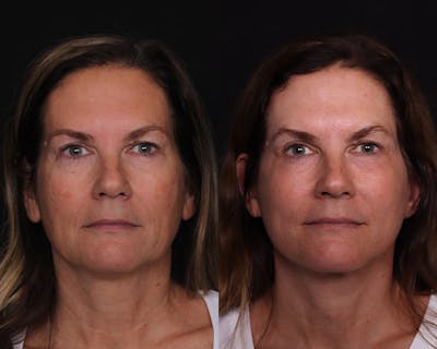 Face & Neck Lift Before & After Gallery - Patient 358649 - Image 1
