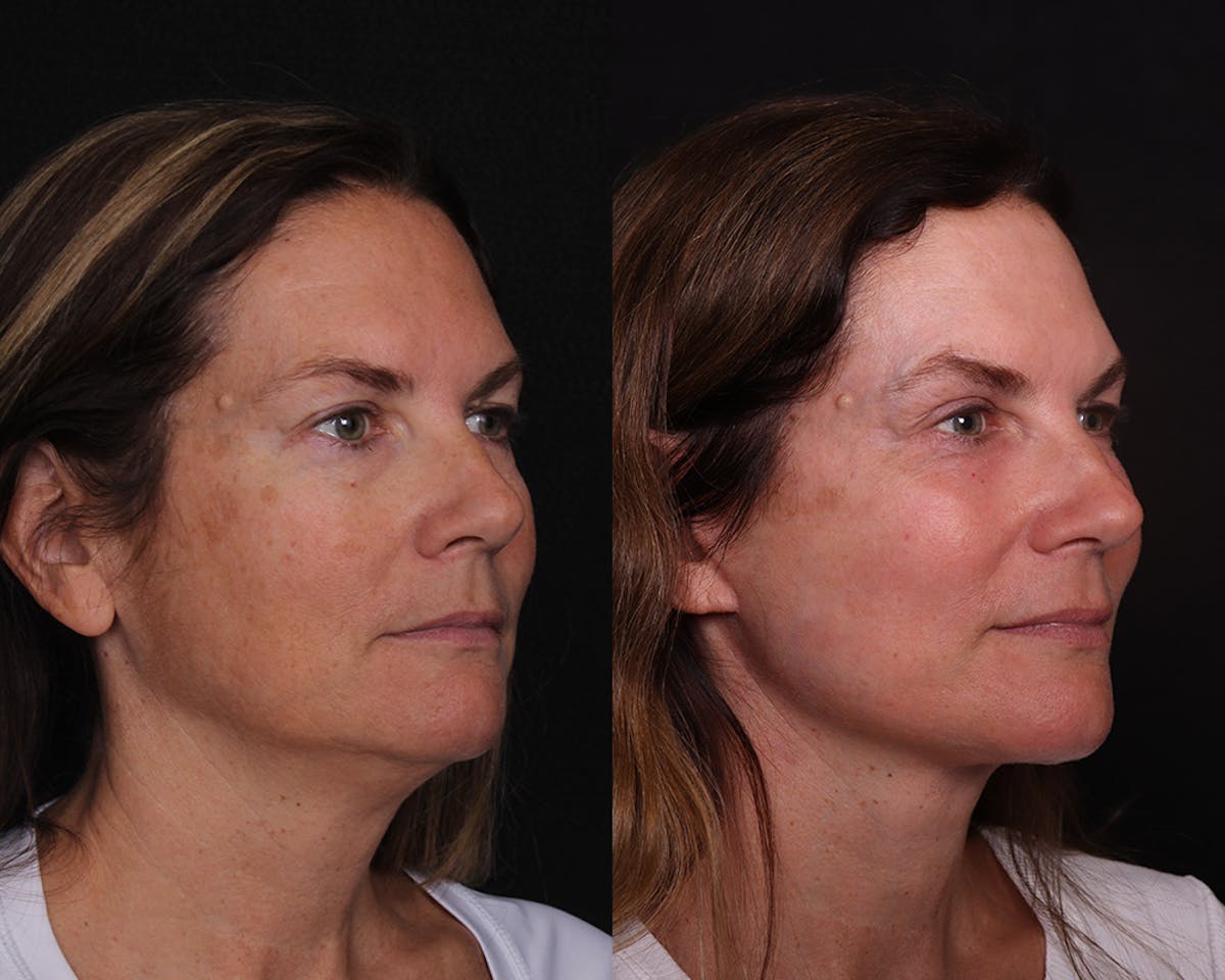 Face & Neck Lift Before & After Gallery - Patient 358649 - Image 2