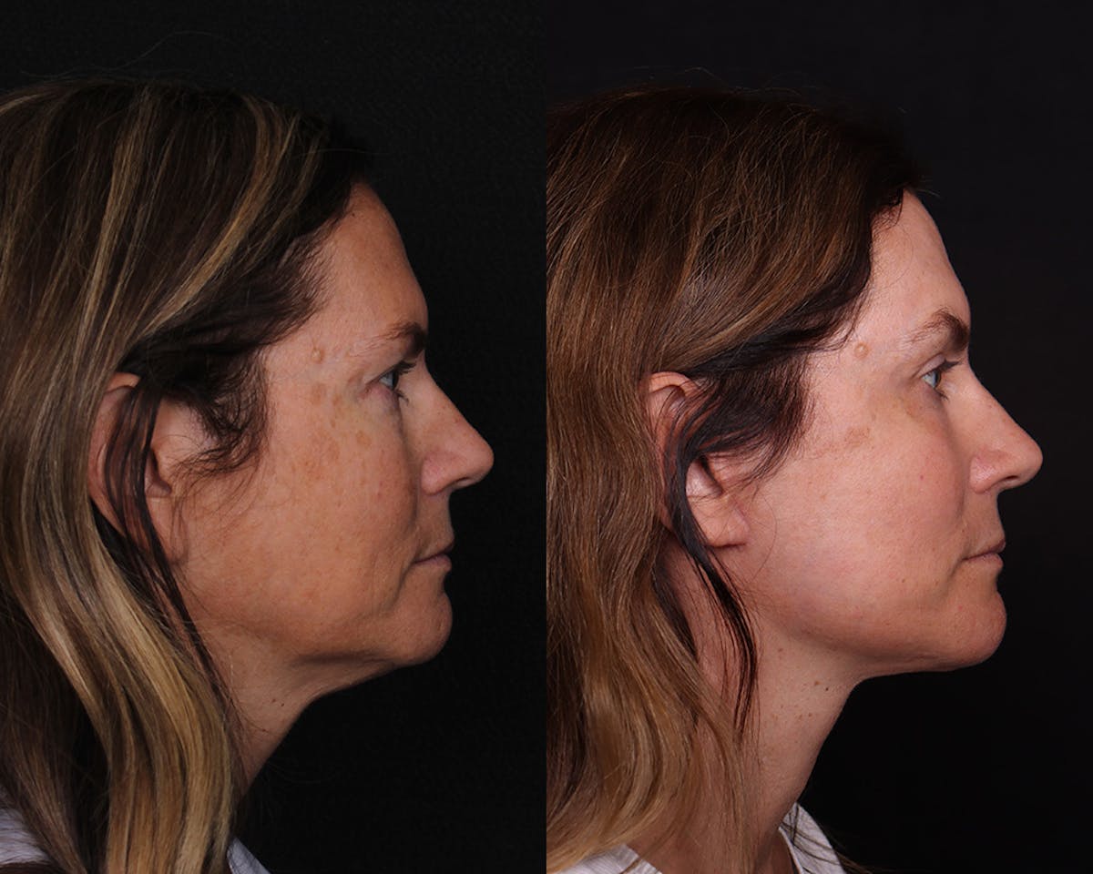 Face & Neck Lift Before & After Gallery - Patient 358649 - Image 3