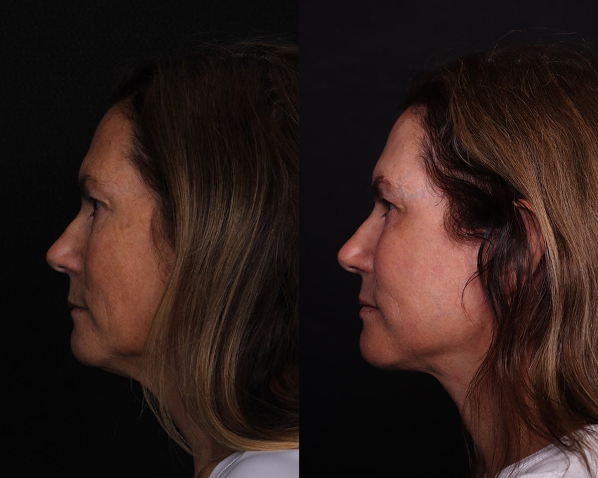 Face & Neck Lift Before & After Gallery - Patient 358649 - Image 5