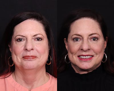Face & Neck Lift Before & After Gallery - Patient 324133 - Image 1