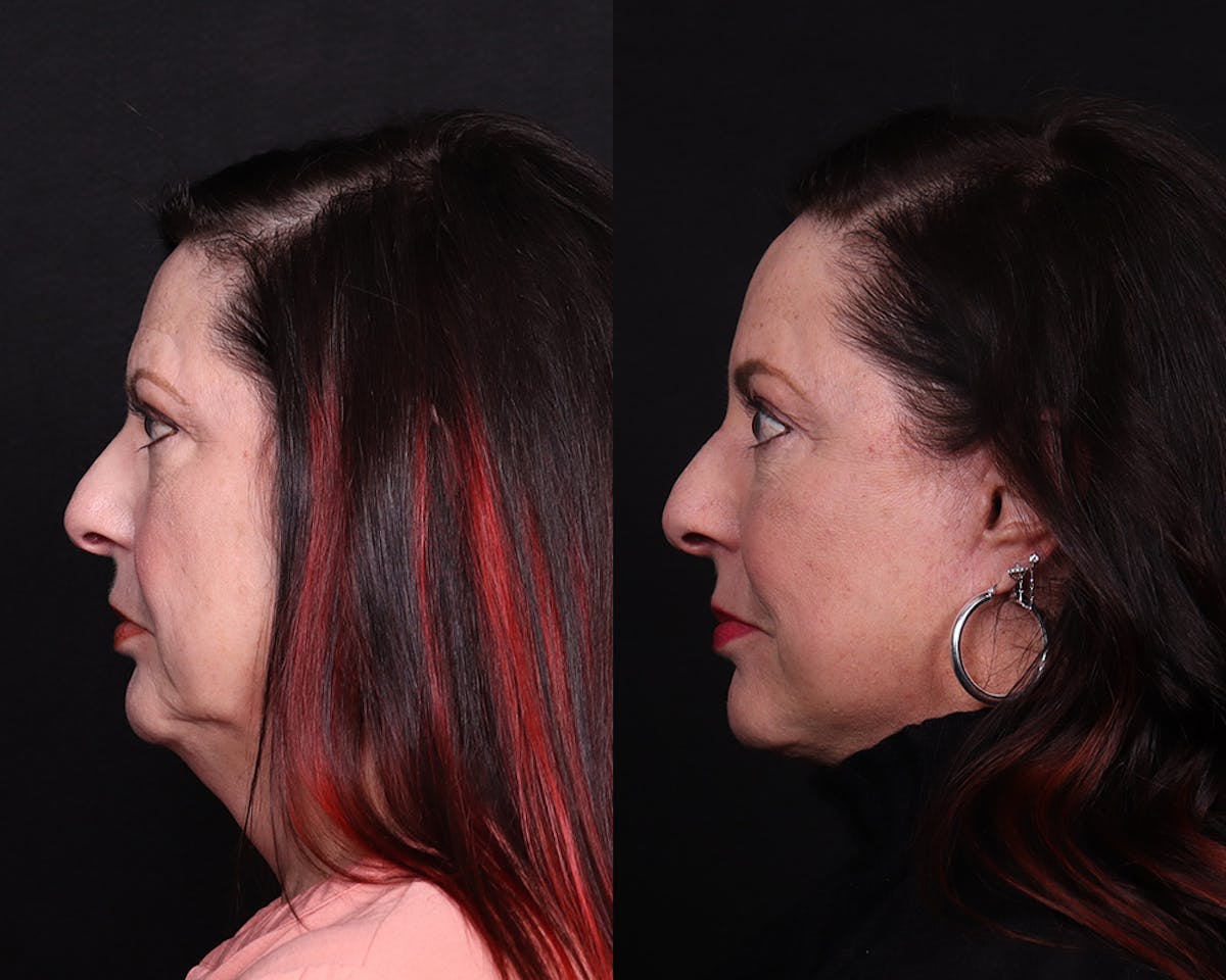 Face & Neck Lift Before & After Gallery - Patient 324133 - Image 5