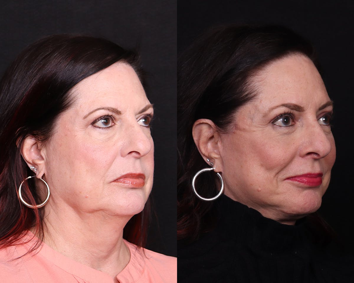Face & Neck Lift Before & After Gallery - Patient 324133 - Image 2