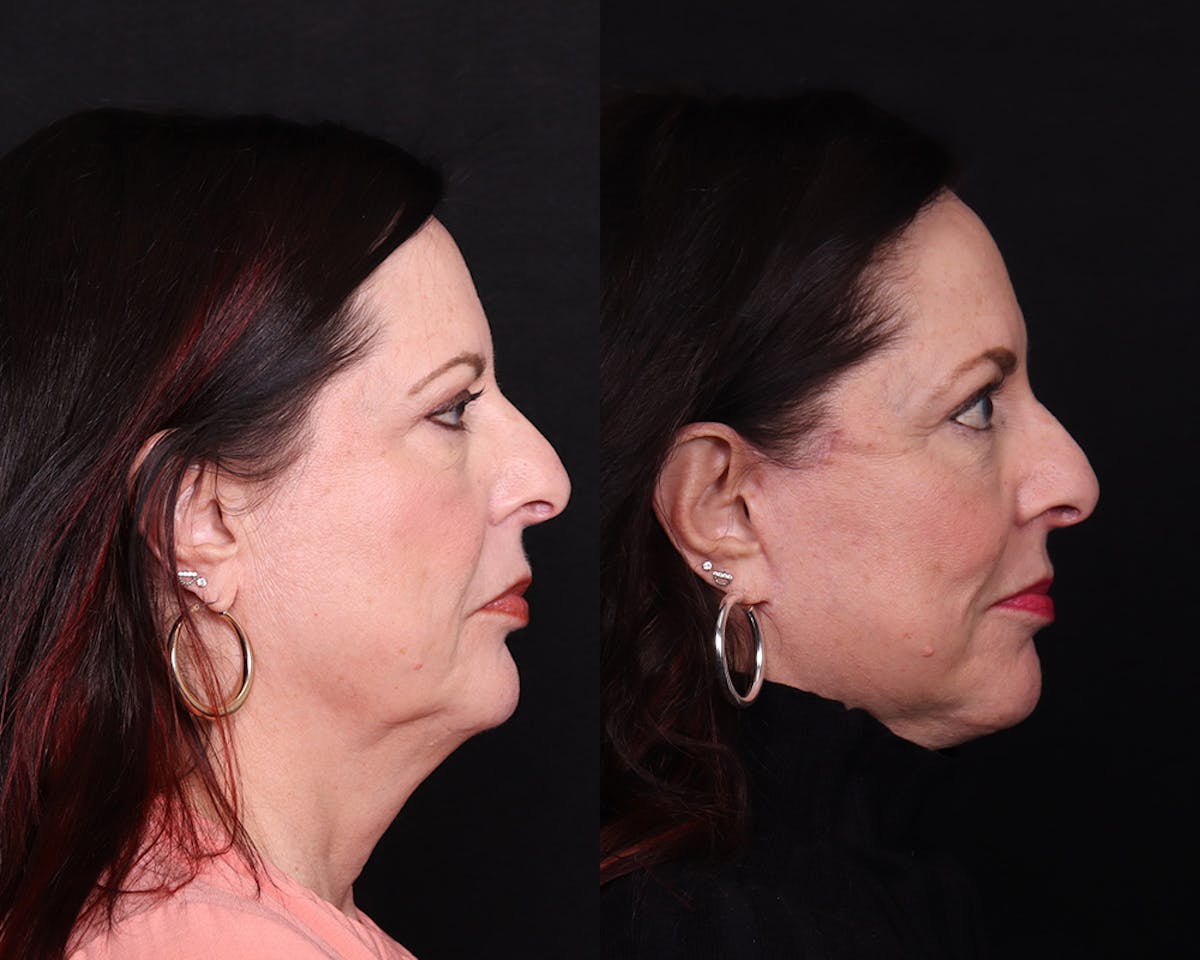 Face & Neck Lift Before & After Gallery - Patient 324133 - Image 3