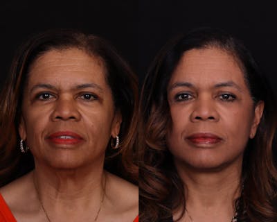 Face & Neck Lift Before & After Gallery - Patient 292159 - Image 1