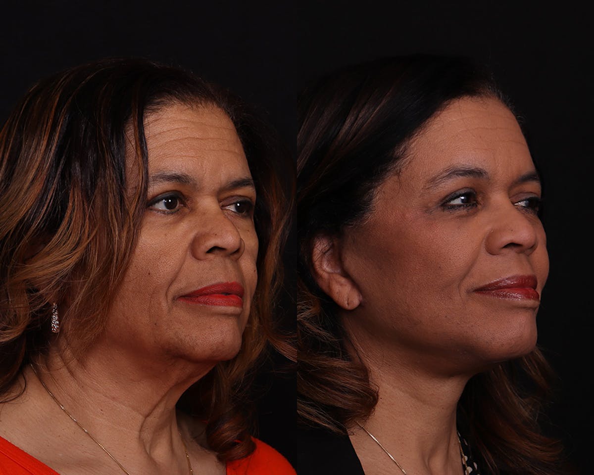 Face & Neck Lift Before & After Gallery - Patient 292159 - Image 2