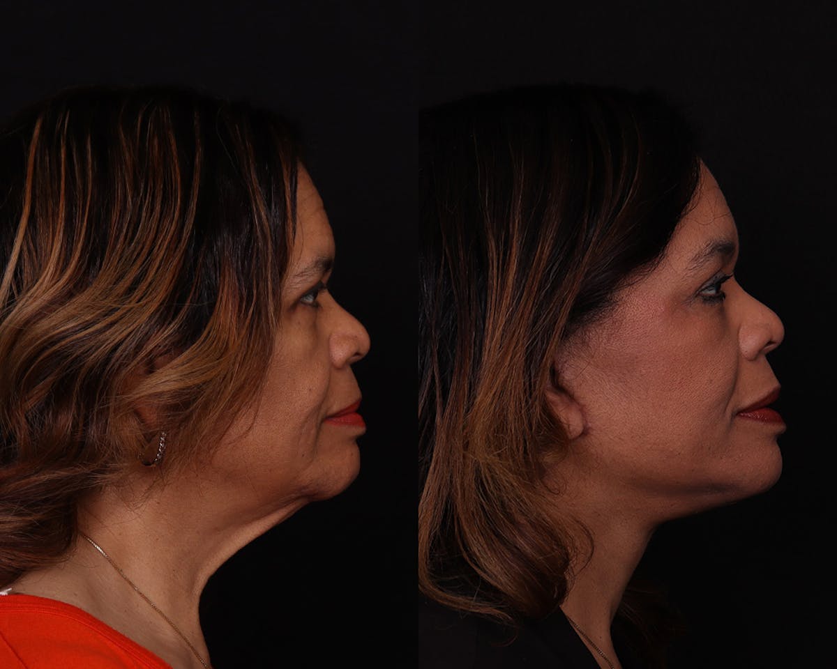 Face & Neck Lift Before & After Gallery - Patient 292159 - Image 3