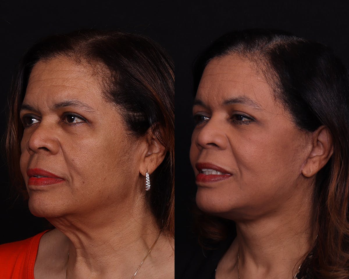 Face & Neck Lift Before & After Gallery - Patient 292159 - Image 4