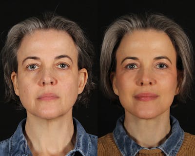 Face & Neck Lift Before & After Gallery - Patient 403501 - Image 1