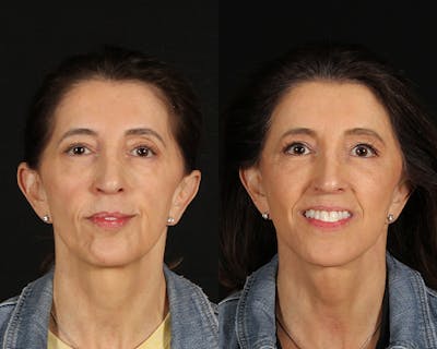 Face & Neck Lift Before & After Gallery - Patient 341845 - Image 1