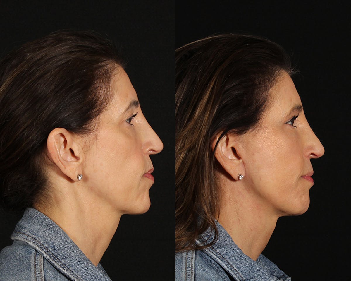 Face & Neck Lift Before & After Gallery - Patient 341845 - Image 3