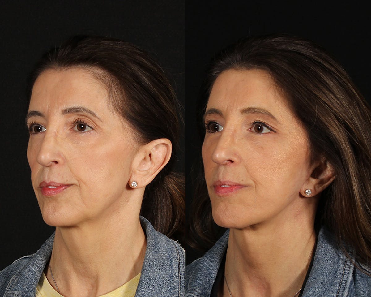Face & Neck Lift Before & After Gallery - Patient 341845 - Image 4