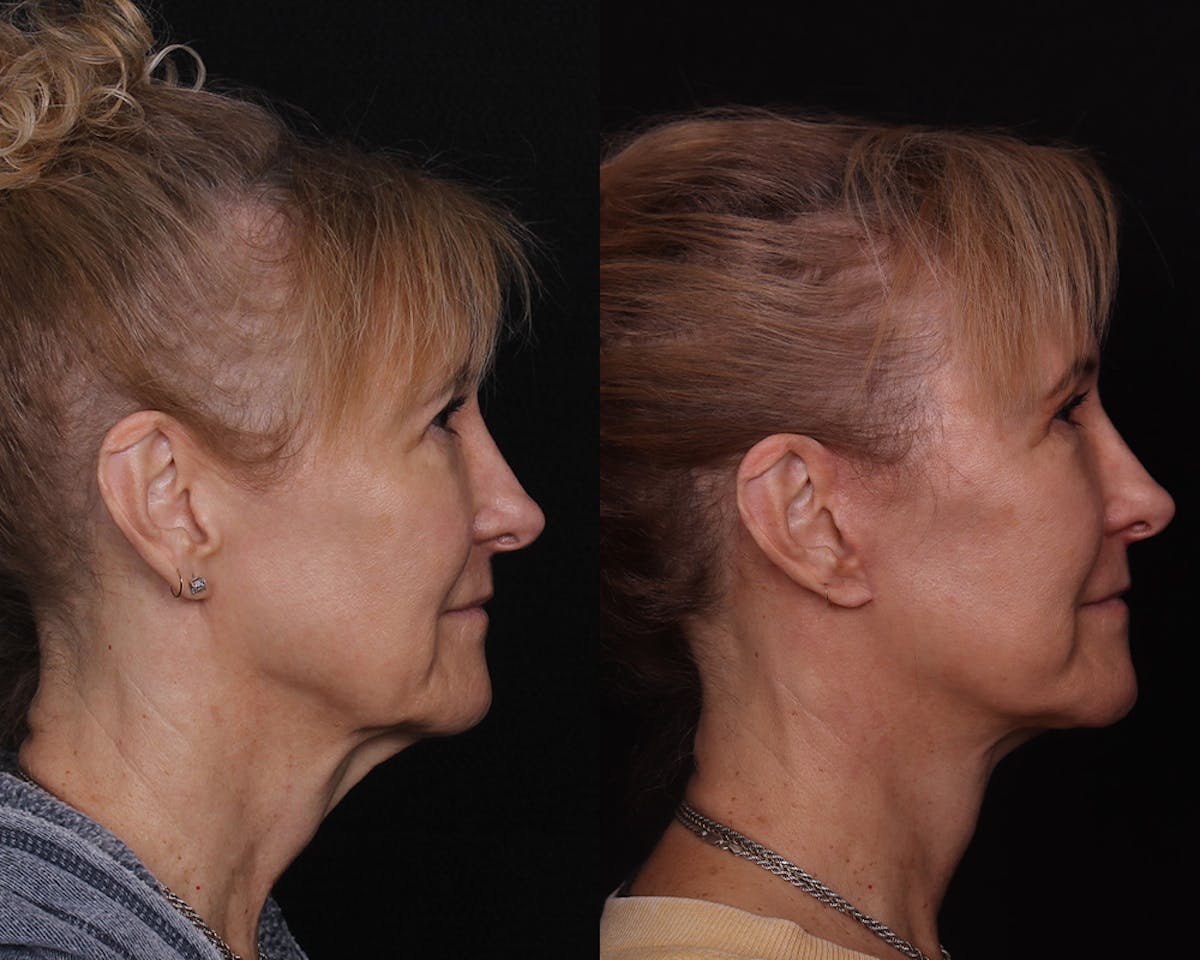 Face & Neck Lift Before & After Gallery - Patient 642136 - Image 3