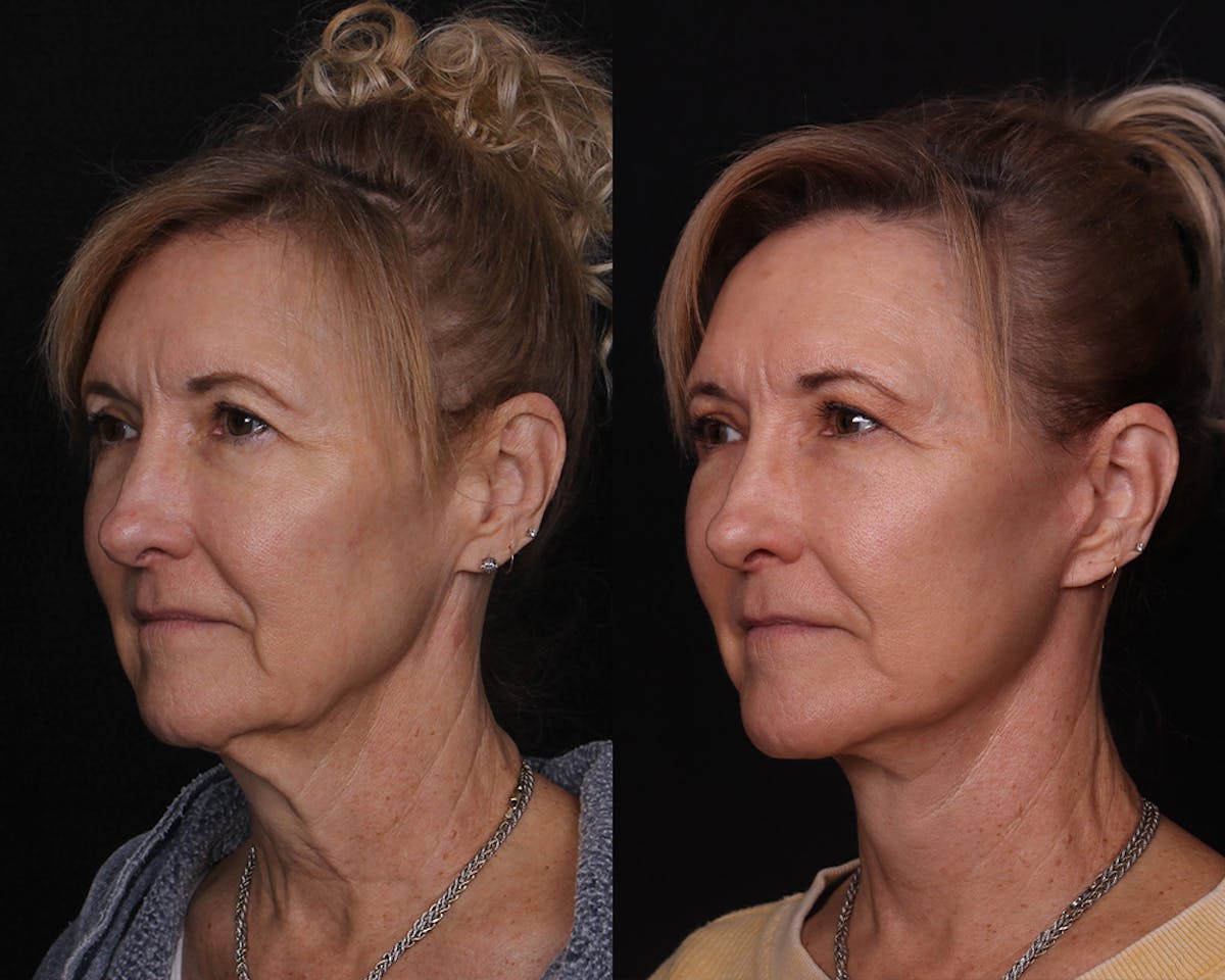 Face & Neck Lift Before & After Gallery - Patient 642136 - Image 4