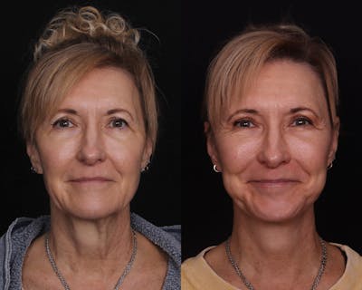 Face & Neck Lift Before & After Gallery - Patient 642136 - Image 1