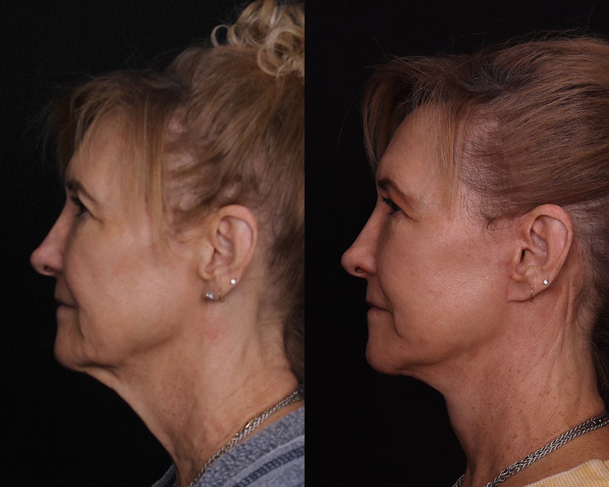 Face & Neck Lift Before & After Gallery - Patient 642136 - Image 5