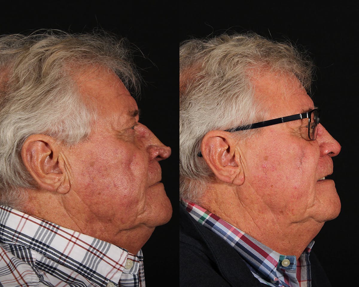 Laser Treatments Before & After Gallery - Patient 699065 - Image 3