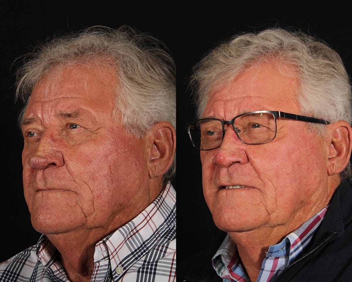 Laser Treatments Before & After Gallery - Patient 699065 - Image 4
