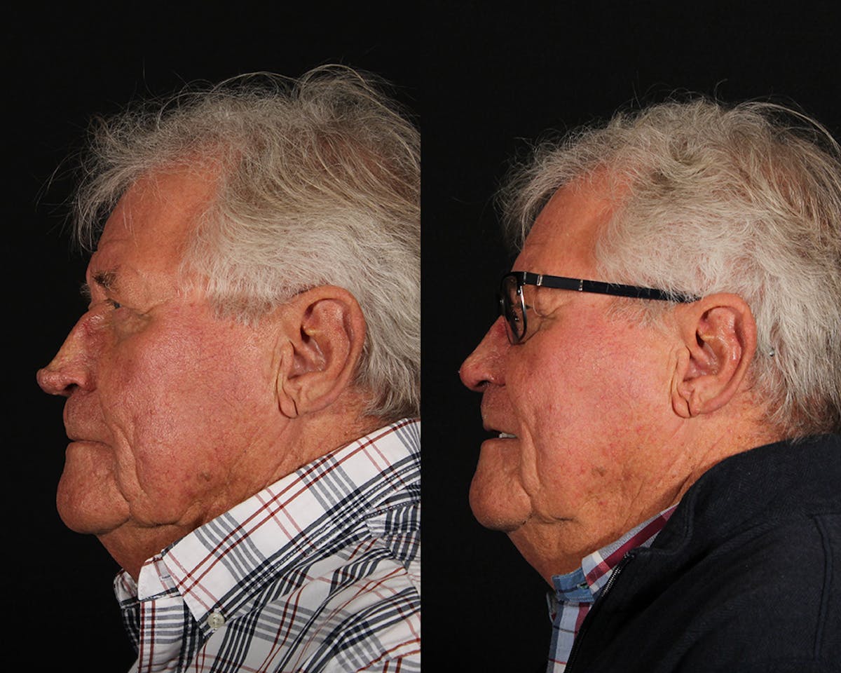 Laser Treatments Before & After Gallery - Patient 699065 - Image 5