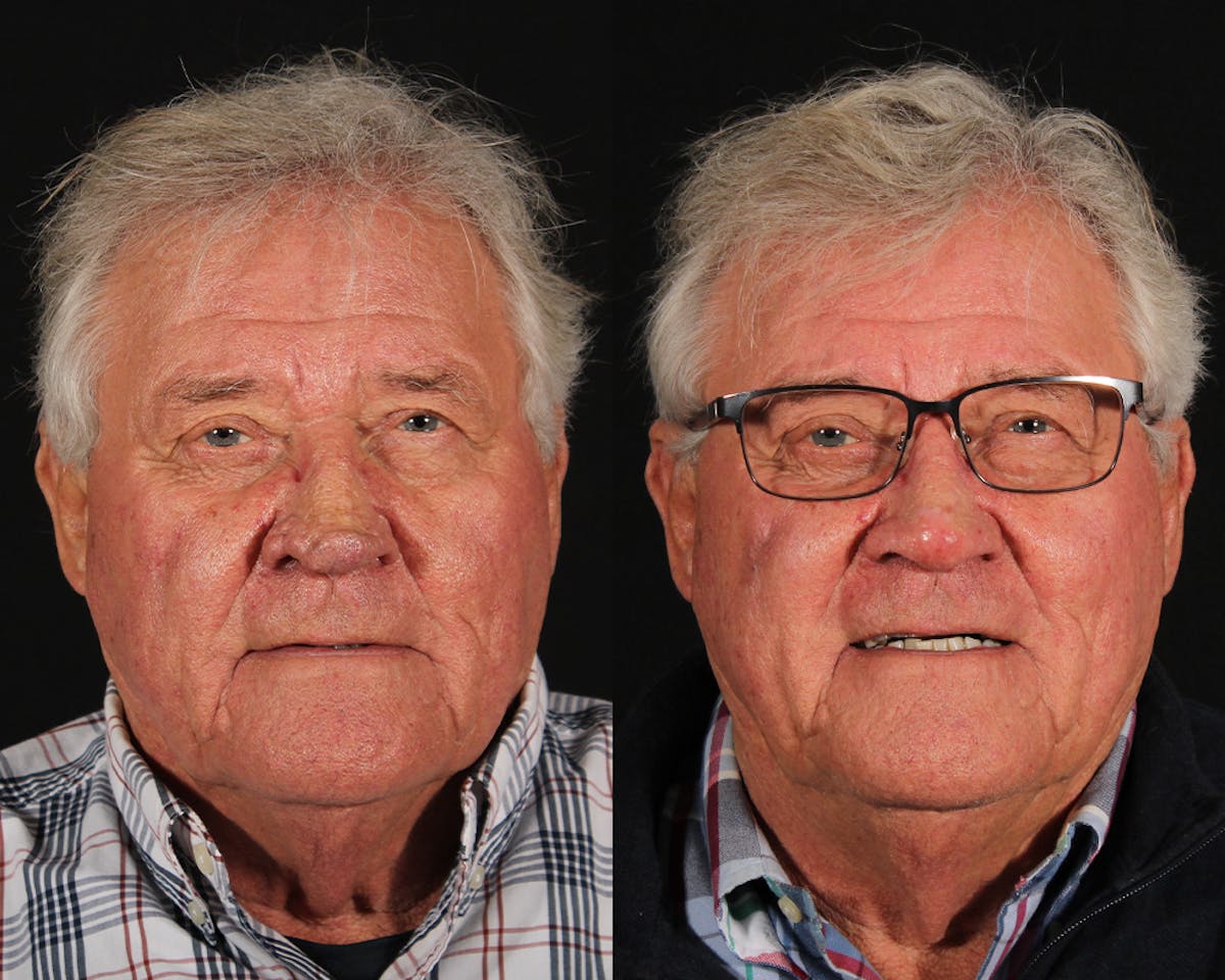 Laser Treatments Before & After Gallery - Patient 699065 - Image 1
