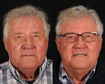 Laser Treatments Before & After Gallery - Patient 699065 - Image 1