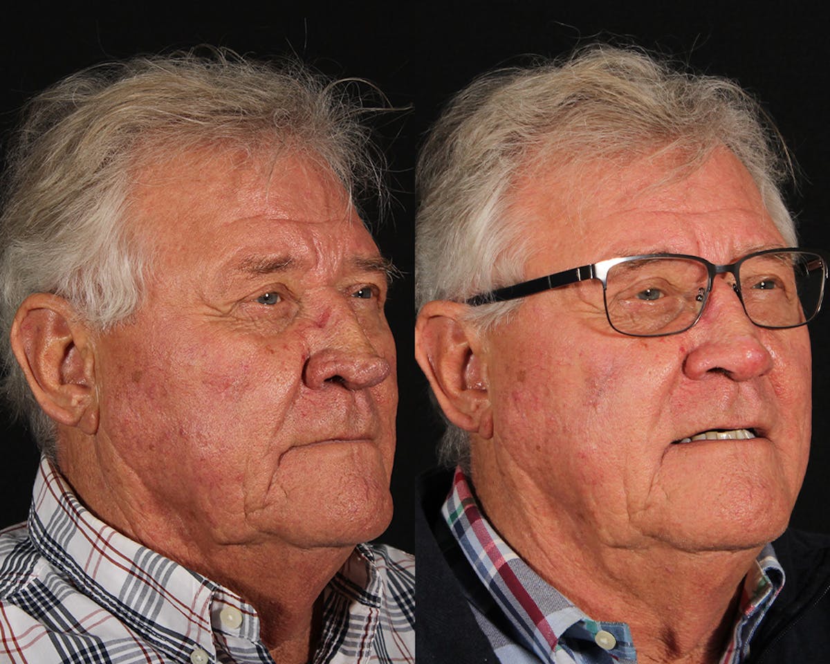 Laser Treatments Before & After Gallery - Patient 699065 - Image 2