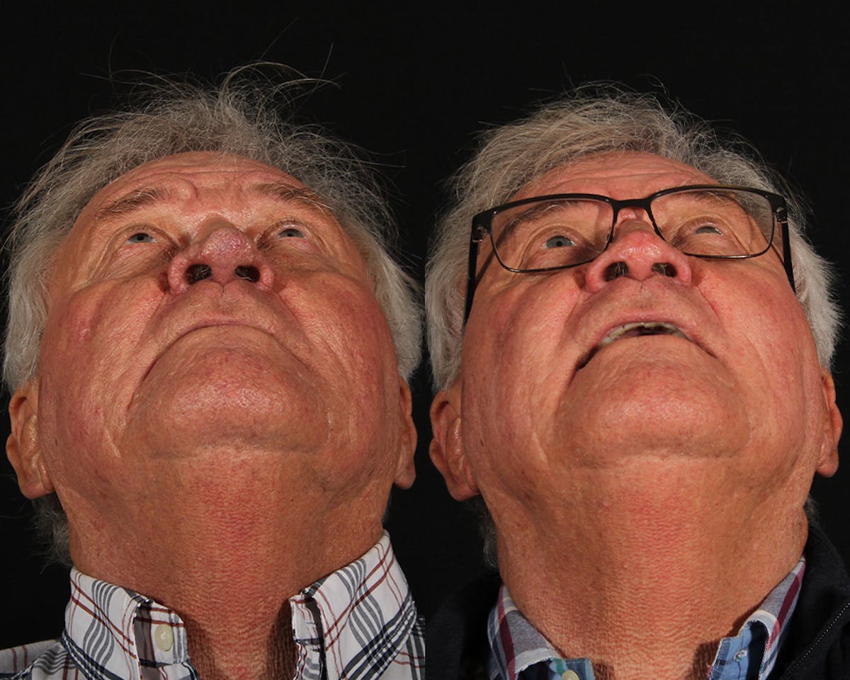 Laser Treatments Before & After Gallery - Patient 699065 - Image 6