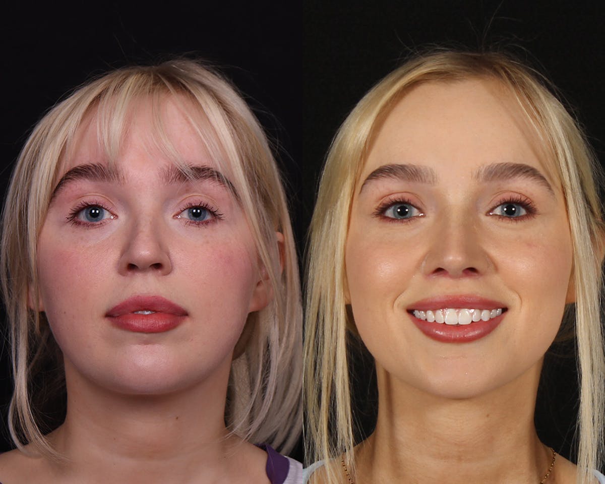 Rhinoplasty Female Before & After Gallery - Patient 113455 - Image 3