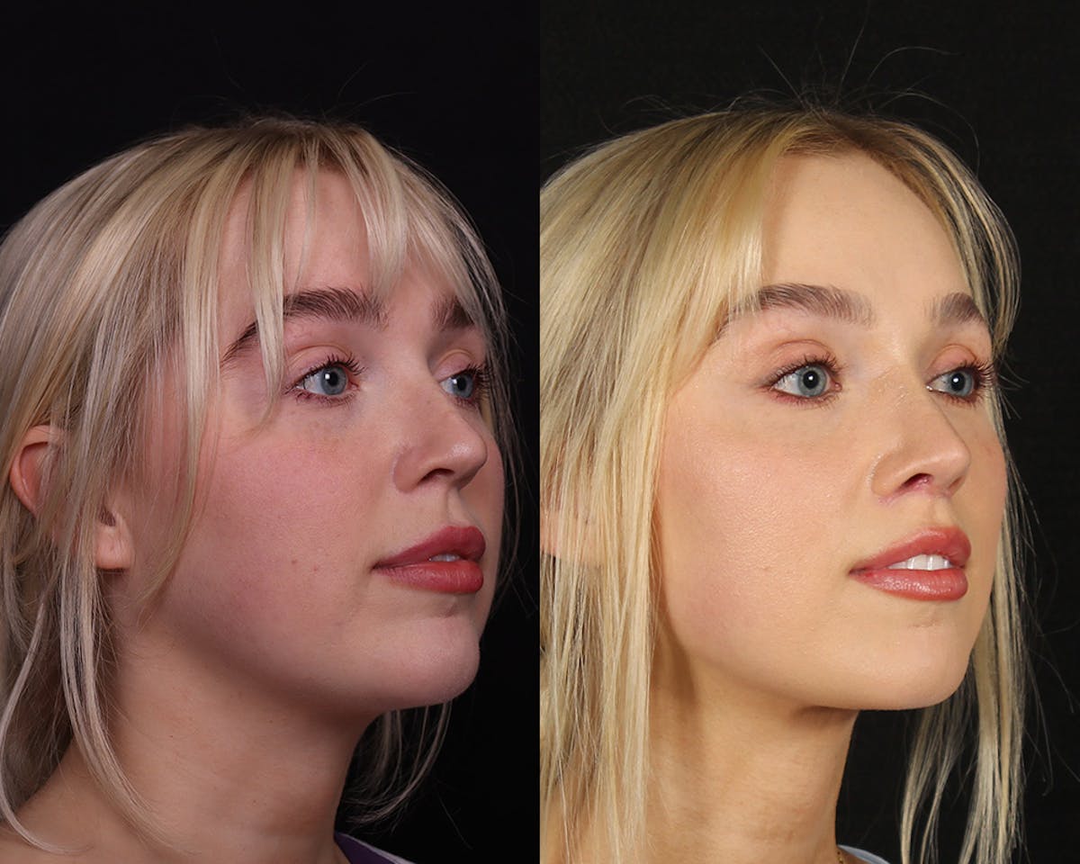 Rhinoplasty Female Before & After Gallery - Patient 113455 - Image 2