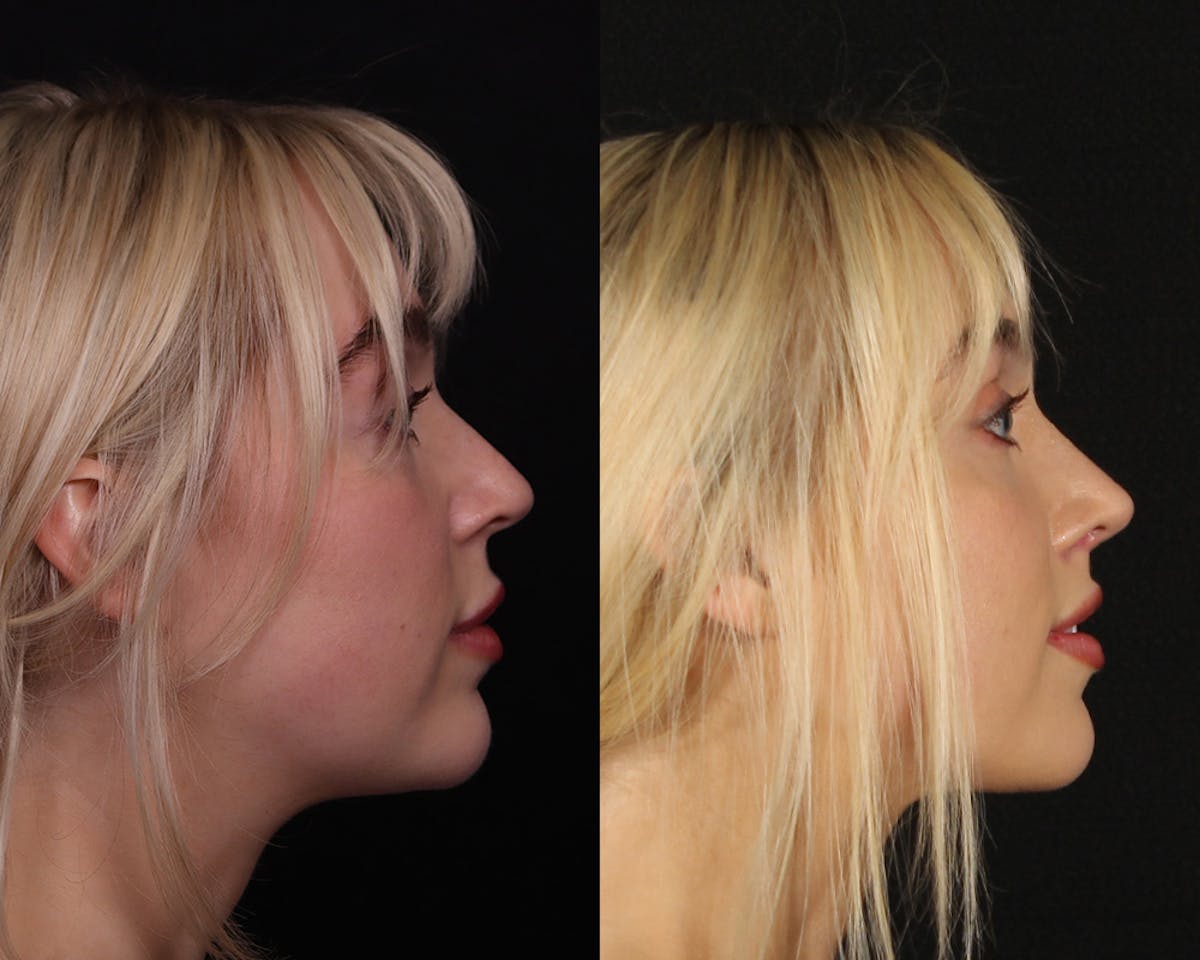 Rhinoplasty Female Before & After Gallery - Patient 113455 - Image 1