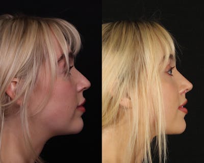 Rhinoplasty Female Before & After Gallery - Patient 113455 - Image 1