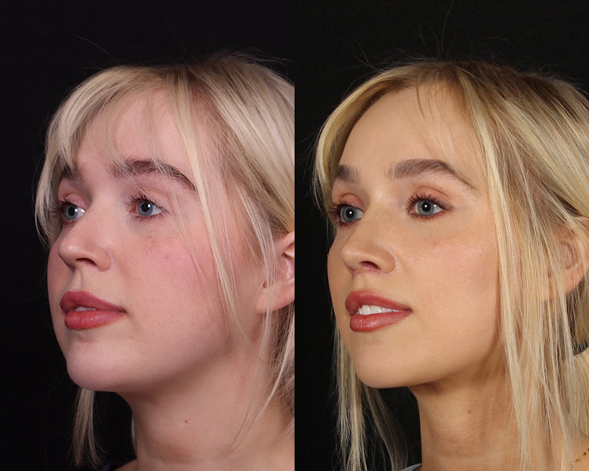 Rhinoplasty Female Before & After Gallery - Patient 113455 - Image 4