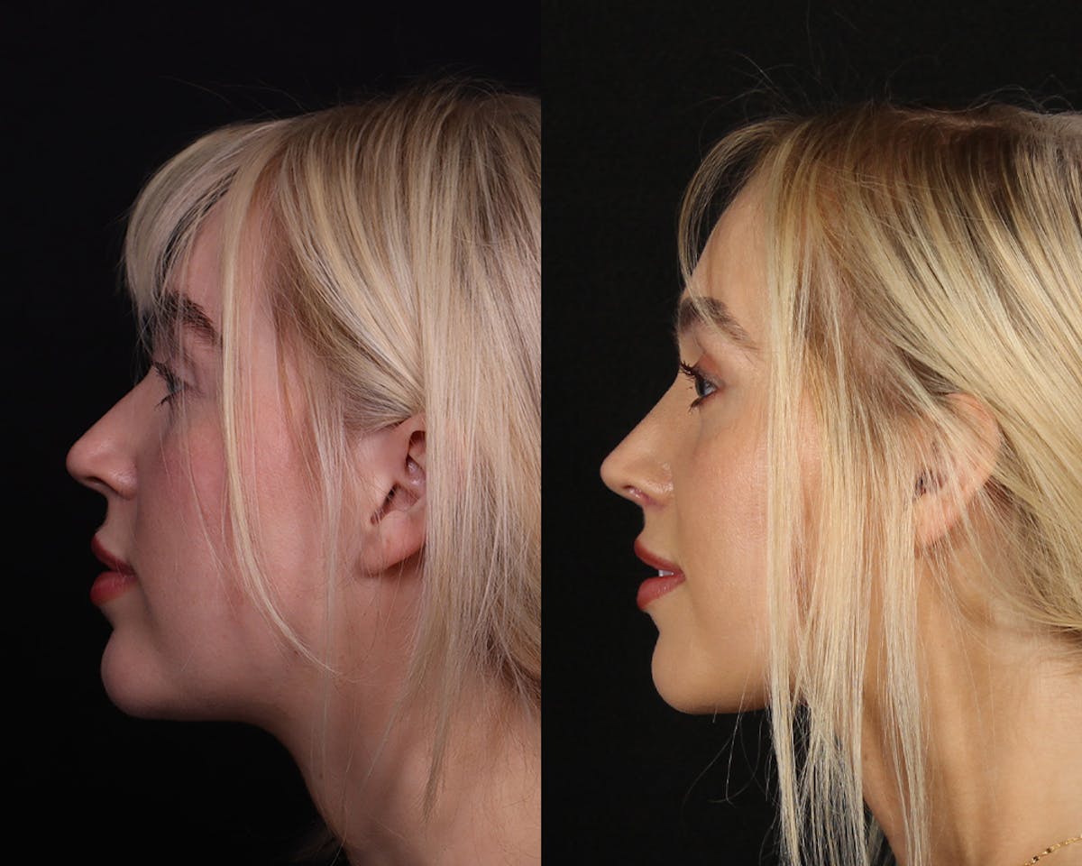 Rhinoplasty Female Before & After Gallery - Patient 113455 - Image 5