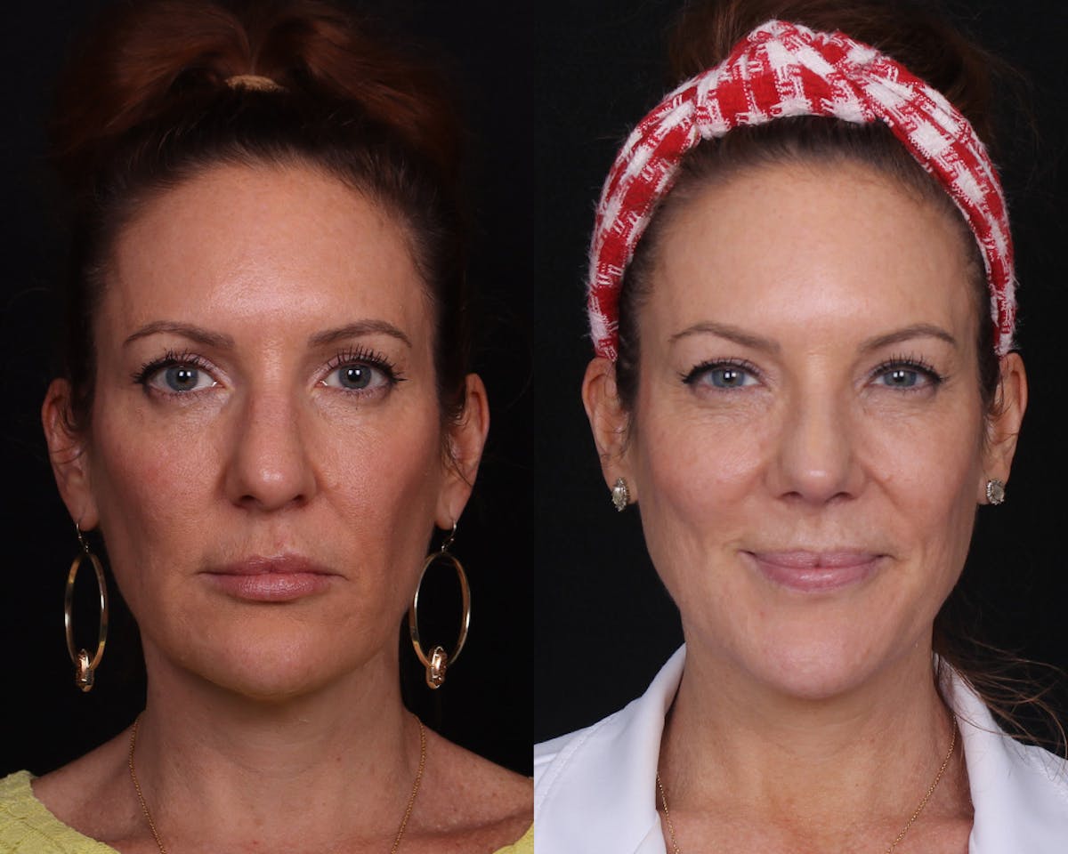 Rhinoplasty Female Before & After Gallery - Patient 234921 - Image 3