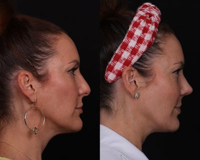 Rhinoplasty Female Before & After Gallery - Patient 234921 - Image 1