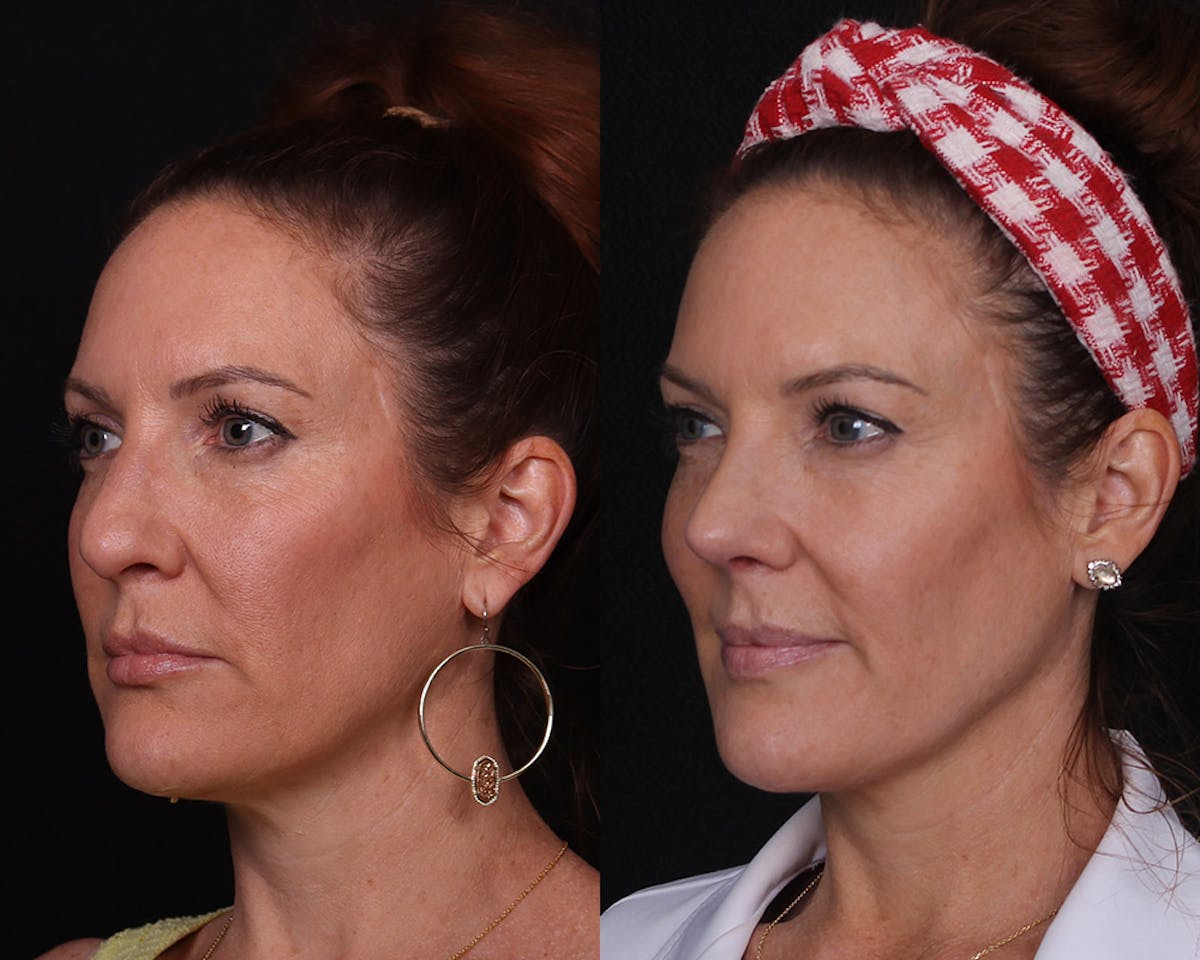 Rhinoplasty Female Before & After Gallery - Patient 234921 - Image 4